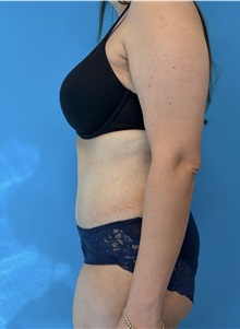 Tummy Tuck After Photo by William Bruno, MD; West Hollywood, CA - Case 51369