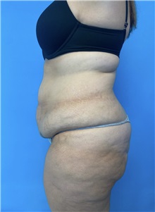 Tummy Tuck Before Photo by William Bruno, MD; West Hollywood, CA - Case 51369