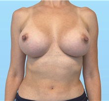 Breast Augmentation After Photo by William Bruno, MD; West Hollywood, CA - Case 51374