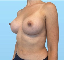 Breast Augmentation After Photo by William Bruno, MD; West Hollywood, CA - Case 51374