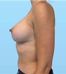 Breast Augmentation After Photo by William Bruno, MD; West Hollywood, CA - Case 51374
