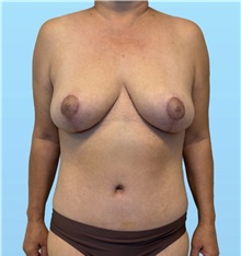 Mommy Makeover After Photo by William Bruno, MD; West Hollywood, CA - Case 51408