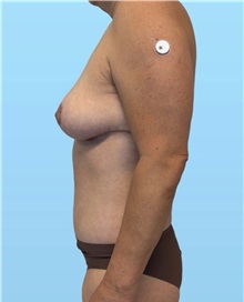 Mommy Makeover After Photo by William Bruno, MD; West Hollywood, CA - Case 51408