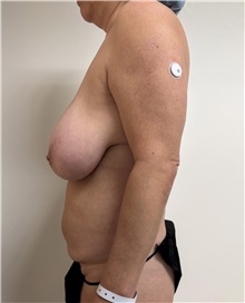 Mommy Makeover Before Photo by William Bruno, MD; West Hollywood, CA - Case 51408