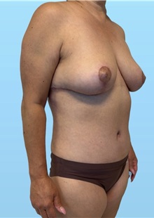 Mommy Makeover After Photo by William Bruno, MD; West Hollywood, CA - Case 51408