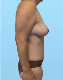 Mommy Makeover After Photo by William Bruno, MD; West Hollywood, CA - Case 51408