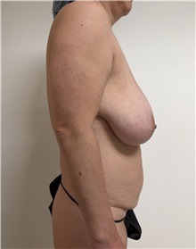 Mommy Makeover Before Photo by William Bruno, MD; West Hollywood, CA - Case 51408