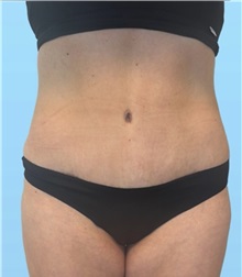 Tummy Tuck After Photo by William Bruno, MD; West Hollywood, CA - Case 51456