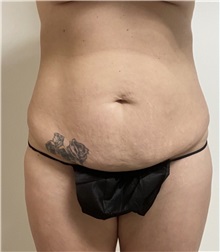 Tummy Tuck Before Photo by William Bruno, MD; West Hollywood, CA - Case 51456