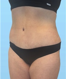 Tummy Tuck After Photo by William Bruno, MD; West Hollywood, CA - Case 51456