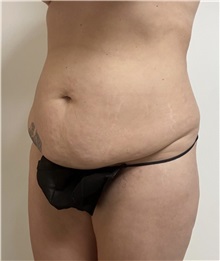 Tummy Tuck Before Photo by William Bruno, MD; West Hollywood, CA - Case 51456