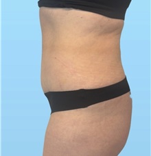Tummy Tuck After Photo by William Bruno, MD; West Hollywood, CA - Case 51456