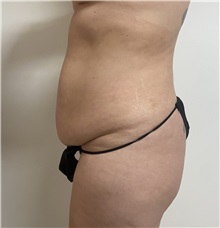 Tummy Tuck Before Photo by William Bruno, MD; West Hollywood, CA - Case 51456