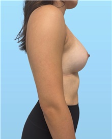 Breast Augmentation After Photo by William Bruno, MD; West Hollywood, CA - Case 51542