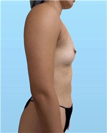 Breast Augmentation Before Photo by William Bruno, MD; West Hollywood, CA - Case 51542