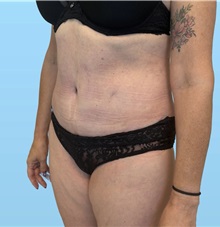 Tummy Tuck After Photo by William Bruno, MD; West Hollywood, CA - Case 51549
