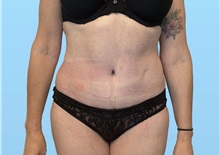 Tummy Tuck After Photo by William Bruno, MD; West Hollywood, CA - Case 51549