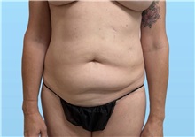 Tummy Tuck Before Photo by William Bruno, MD; West Hollywood, CA - Case 51549