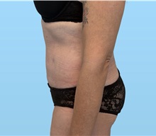 Tummy Tuck After Photo by William Bruno, MD; West Hollywood, CA - Case 51549