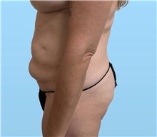 Tummy Tuck Before Photo by William Bruno, MD; West Hollywood, CA - Case 51549