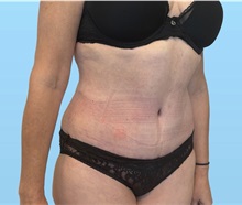 Tummy Tuck After Photo by William Bruno, MD; West Hollywood, CA - Case 51549