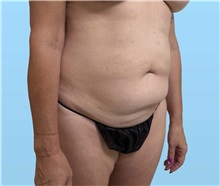 Tummy Tuck Before Photo by William Bruno, MD; West Hollywood, CA - Case 51549