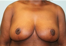 Breast Reduction After Photo by Hampton Howell, MD; Winston-Salem, NC - Case 38024