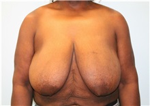 Breast Reduction Before Photo by Hampton Howell, MD; Winston-Salem, NC - Case 38024