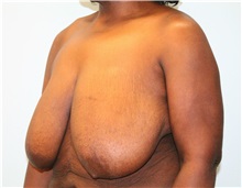 Breast Reduction After Photo by Hampton Howell, MD; Winston-Salem, NC - Case 38024
