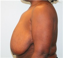 Breast Reduction Before Photo by Hampton Howell, MD; Winston-Salem, NC - Case 38024