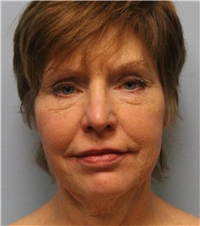 Facelift Before Photo by Hampton Howell, MD; Winston-Salem, NC - Case 38358