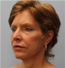 Facelift After Photo by Hampton Howell, MD; Winston-Salem, NC - Case 38358