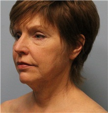 Facelift Before Photo by Hampton Howell, MD; Winston-Salem, NC - Case 38358