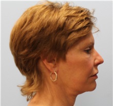 Facelift After Photo by Hampton Howell, MD; Winston-Salem, NC - Case 38358