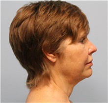 Facelift Before Photo by Hampton Howell, MD; Winston-Salem, NC - Case 38358