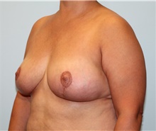 Breast Reduction After Photo by Hampton Howell, MD; Winston-Salem, NC - Case 39879