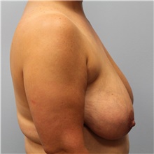 Breast Reduction Before Photo by Hampton Howell, MD; Winston-Salem, NC - Case 39879