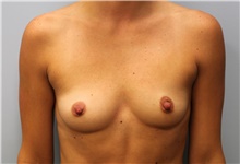 Breast Augmentation Before Photo by Hampton Howell, MD; Winston-Salem, NC - Case 39882