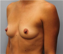 Breast Augmentation Before Photo by Hampton Howell, MD; Winston-Salem, NC - Case 39882