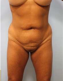 Liposuction Before Photo by Hampton Howell, MD; Winston-Salem, NC - Case 40716
