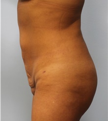 Liposuction After Photo by Hampton Howell, MD; Winston-Salem, NC - Case 40716