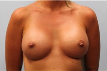 Breast Augmentation After Photo by Hampton Howell, MD; Winston-Salem, NC - Case 40717