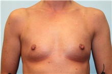 Breast Augmentation Before Photo by Hampton Howell, MD; Winston-Salem, NC - Case 40717