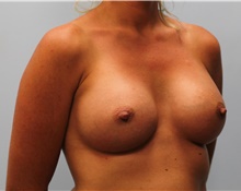 Breast Augmentation After Photo by Hampton Howell, MD; Winston-Salem, NC - Case 40717