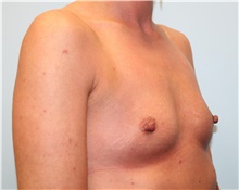 Breast Augmentation Before Photo by Hampton Howell, MD; Winston-Salem, NC - Case 40717