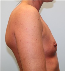 Breast Augmentation Before Photo by Hampton Howell, MD; Winston-Salem, NC - Case 40717