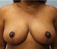 Breast Reduction After Photo by Hampton Howell, MD; Winston-Salem, NC - Case 40720