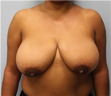 Breast Reduction Before Photo by Hampton Howell, MD; Winston-Salem, NC - Case 40720