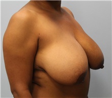 Breast Reduction Before Photo by Hampton Howell, MD; Winston-Salem, NC - Case 40720