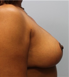 Breast Reduction After Photo by Hampton Howell, MD; Winston-Salem, NC - Case 40720
